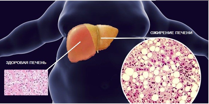 Что приводит к  ожирению печени
